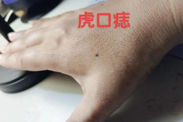 白虎痣相;虎口张痣好不好