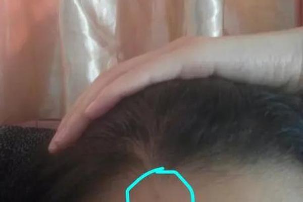 发际线里痣相(发际线旁边的痣)