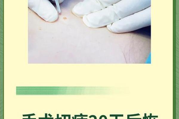 相城医院手术切痣多少钱、医院切痣 手术价格