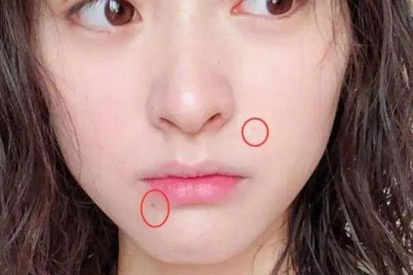左边嘴角偏下去有痣是相、嘴角左下有痣好不好