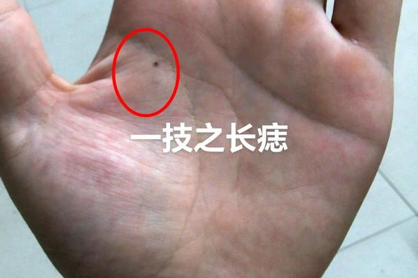男孩左手手掌有痣相(男生左手掌下突然长痣) 男孩左手手掌有痣相(男生左手掌下突然长痣)