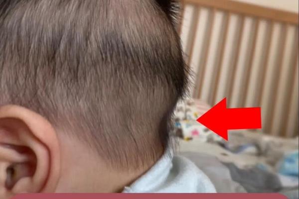 一个月男婴后脑勺有痣相(后脑勺下面有痣图解)
