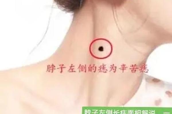 痣相脖子痣—脖颈有痣 痣相图解