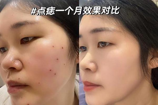 苏州相城哪家激光祛痣好,激光祛痣多久能恢复 苏州相城哪家激光祛痣好,激光祛痣多久能恢复