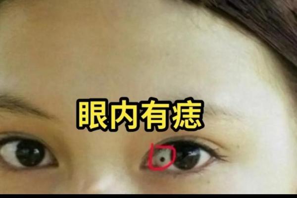痣相白色的痣_白色的痣叫什么痣