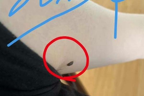 右腋下有痣女人体相,女人右腋下有痣好不好