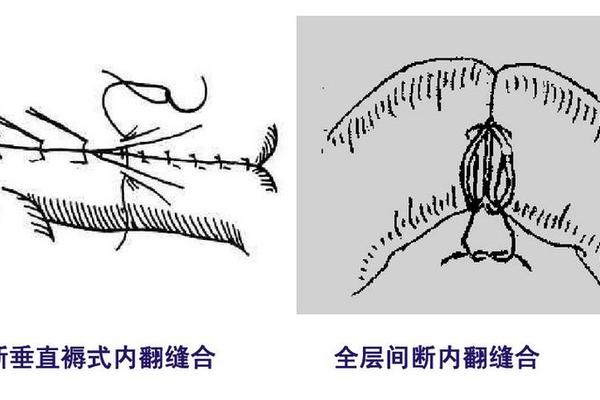 内八字缝合
