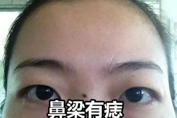 鼻上长痣的相-鼻梁长痣好不好