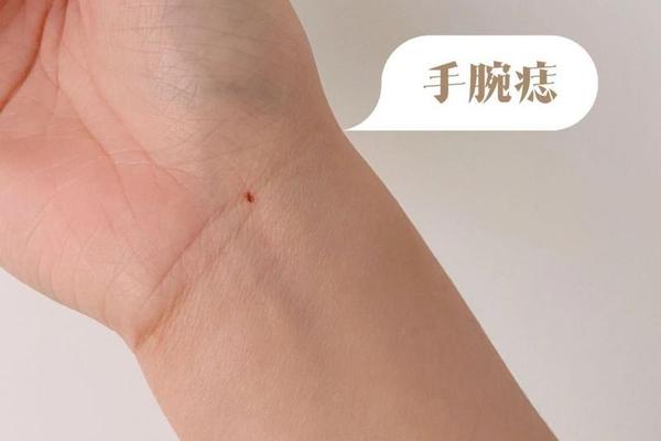 手腕痣相解析(手腕的痣的位置与命运图解)