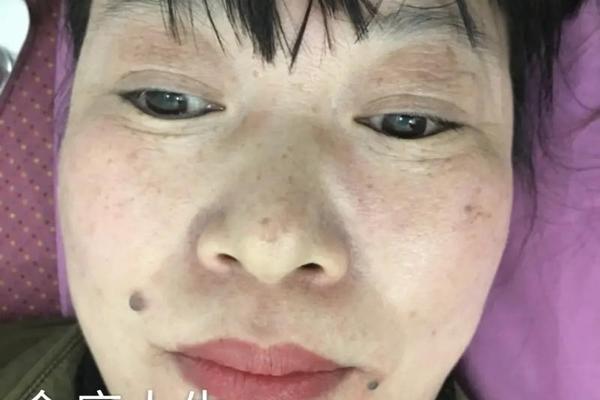 口角痣相_嘴角的痣是好还是坏