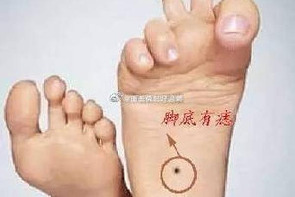 痣相女人脚上痣相图解、女士脚上痣相