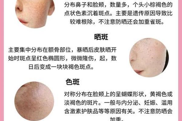 痣斑纹相-痣与斑的区别图片