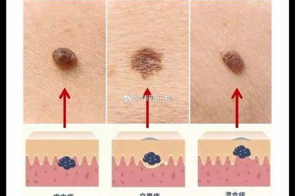 跟皮肤相平的痣;平的痣和凸起的痣有什么区别