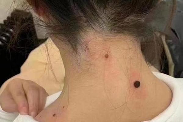 脖子后有痣痣相;后脖子有痣的人