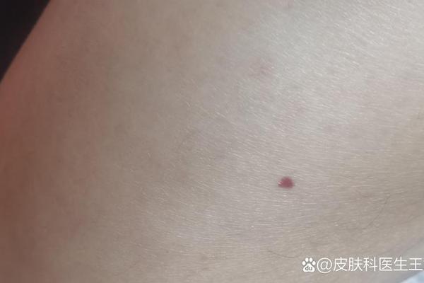 相法 小腹部红痣 腹部有红痣代表什么 相法 小腹部红痣 腹部有红痣代表什么
