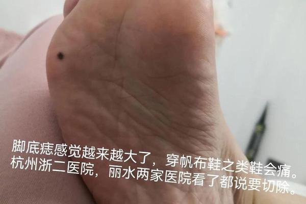 左脚心上痣相-左脚心长痣的男人