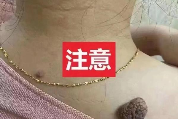 男脖子痣相_男人后颈左侧有痣图解
