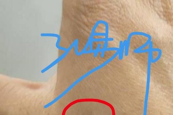 小虎牙大痣相 面相痣的图片大全