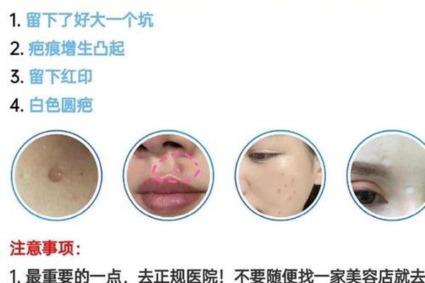相城点痣哪个医院好些_苏州哪里点痣比较好