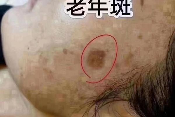 老人言痣相—老年痣是什么样的图片
