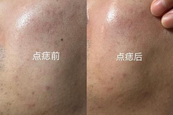 点痣有没有改相_点痣真的能改运吗