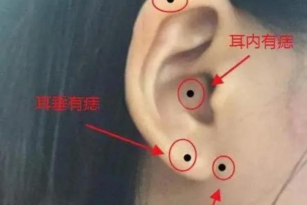 女相耳旁长颗痣_两边耳朵长痣代表什么 女相耳旁长颗痣_两边耳朵长痣代表什么