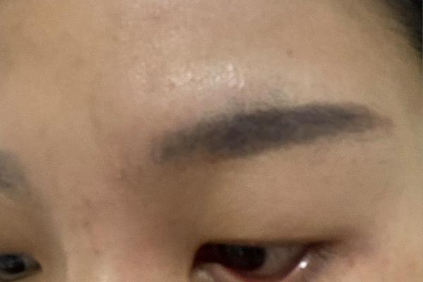 痣相眼皮长红痣_眼皮长个红痣代表什么意思 痣相眼皮长红痣_眼皮长个红痣代表什么意思