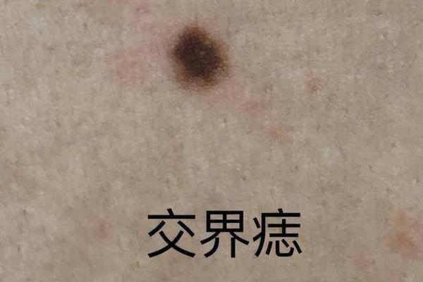 痣相运程_面部长痣全部图 痣相运程_面部长痣全部图