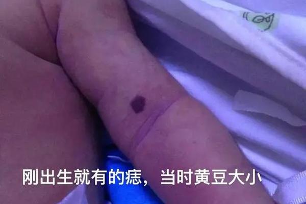出生痣相(宝宝出生就有痣正常吗) 出生痣相(宝宝出生就有痣正常吗)