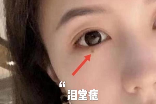 右眼有泪痣相(右眼有泪痣代表什么)