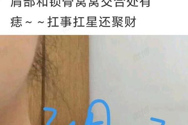 痣相肩、肩膀上的痣是什么痣 痣相肩、肩膀上的痣是什么痣