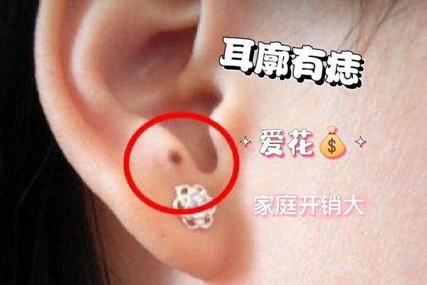 耳郭的痣相;耳廓上的痣好吗