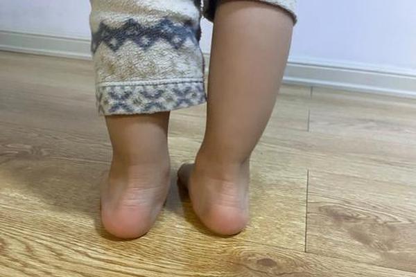 小孩走路内八字 小孩走路内八字