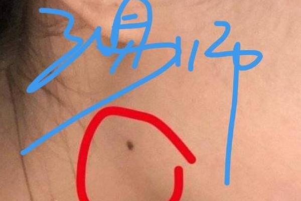 腮腺痣相-腮帮子上的痣 腮腺痣相-腮帮子上的痣