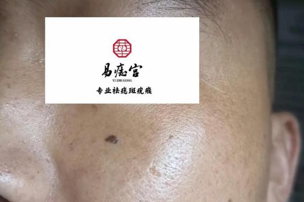 相不独论泪堂有痣_泪堂痣的正确位置图片