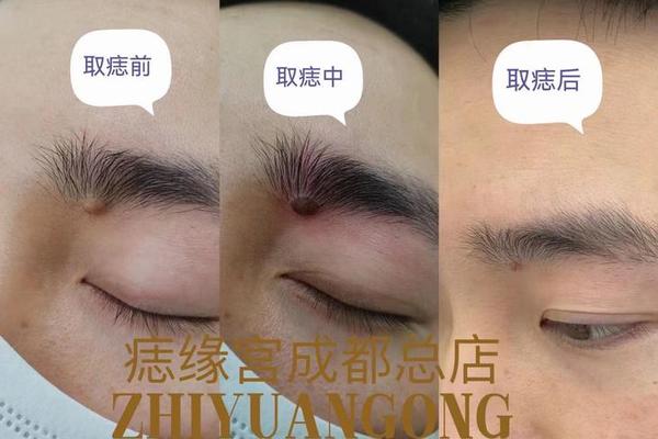 相城哪里有点痣的医院啊_苏州哪里点痣比较好