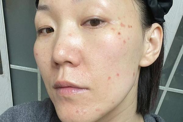 b619相机怎样去痣;激萌相机怎么去痣