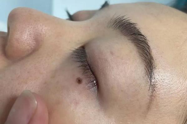 眼睛上下的痣相-眼睛下面对称的痣