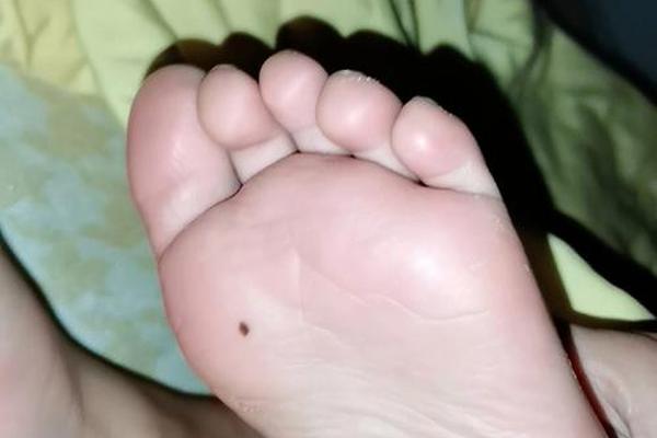 脚底长痣的富相痣、脚上突然长痣 脚底长痣的富相痣、脚上突然长痣